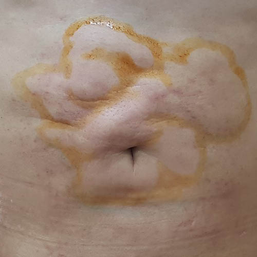 지방흡입 후 울퉁불퉁한 유착