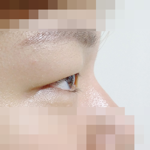 두꺼운 눈두덩이